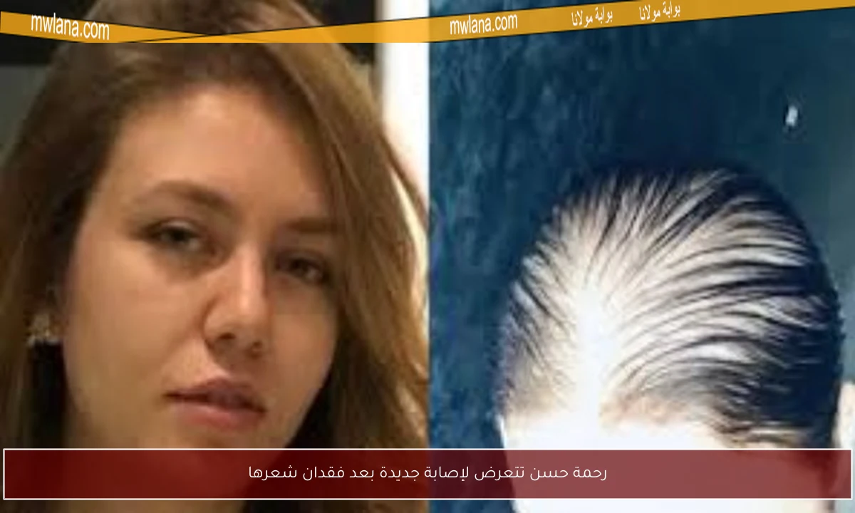 رحمة حسن تتعرض لإصابة جديدة بعد فقدان شعرها